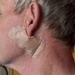 Đầu bếp Gordon Ramsay phẫu thuật loại bỏ ung thư da gần tai