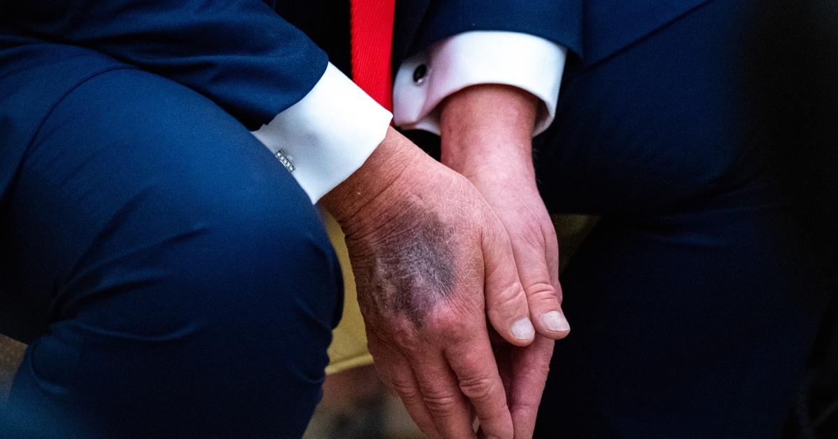 250902 donald trump bruise hand 01 cs 4dc4ba