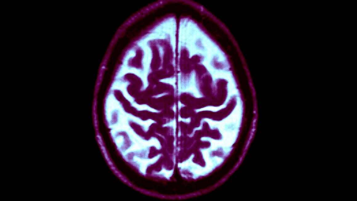 Cử tri Texas chấp thuận Đề xuất 14, thành lập cơ sở nghiên cứu bệnh mất trí nhớ 1 MRI