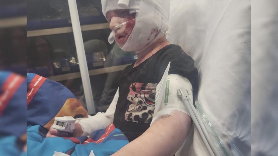 Kinh hoàng: Bé trai 4 tuổi bị chó tấn công, đứt lìa tai 1 0323d79b 4592 4724 a729