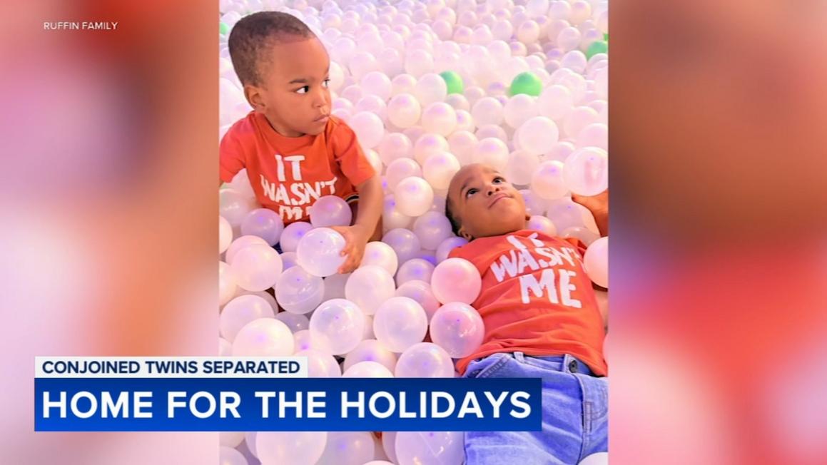 18313087 122425 wpvi chop conjoined twins folo 430pm video vid