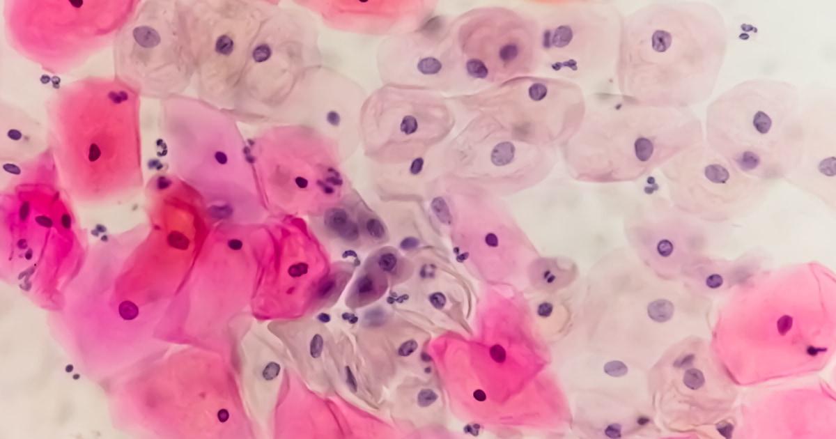 240119 cervical cancer mn 1135 c2a6b7