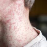 Dịch bệnh sởi bùng phát, Hoa Kỳ có thể mất ‘trạng thái loại trừ’?