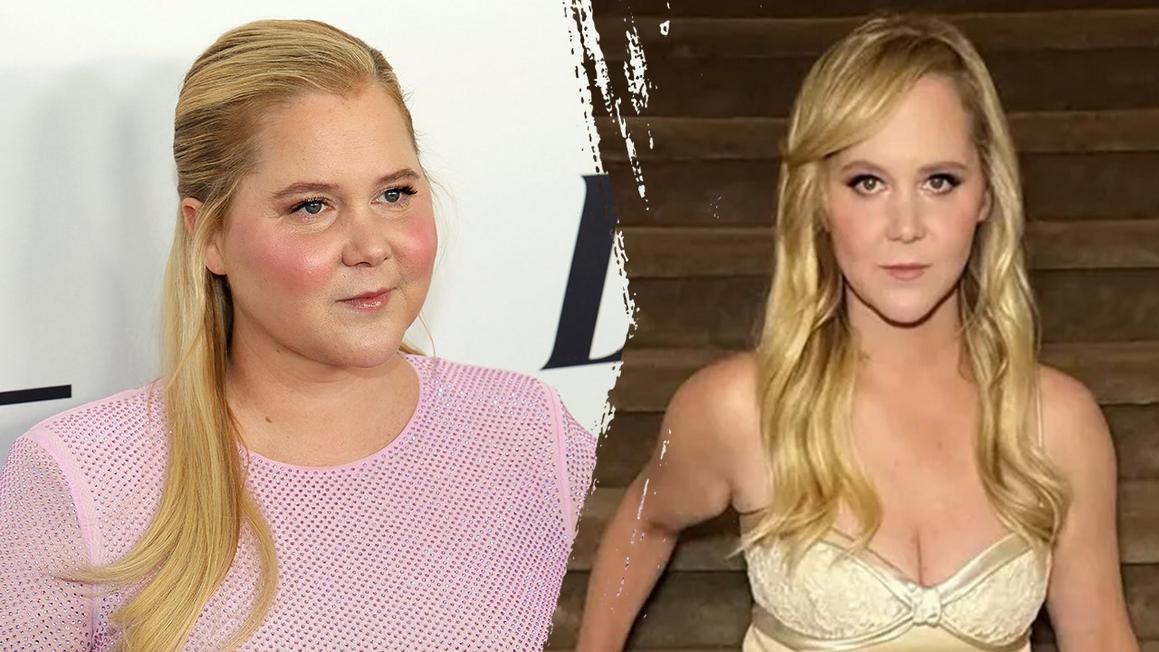 Bệnh Cushing: Amy Schumer Giảm Cân Kịch Tính Vì Gì? 1 amy schumer before after weight loss