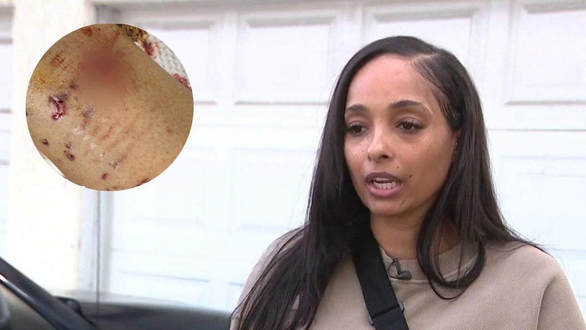 Người phụ nữ ở Nam Los Angeles bị chó pit bull của hàng xóm tấn công; Cảnh sát và Dịch vụ Động vật không thể giúp 1 cms 1280x 720 2026 01 06t174134.971