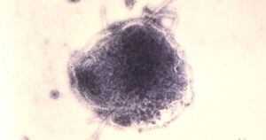 Dịch bệnh sởi bùng phát tại Hạt Snohomish, WA