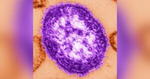 3 Thêm Trẻ Em Ở Quận Snohomish, Washington Nhiễm Sởi 16 3 Thêm Trẻ Em Ở Quận Snohomish, Washington Nhiễm Sởi