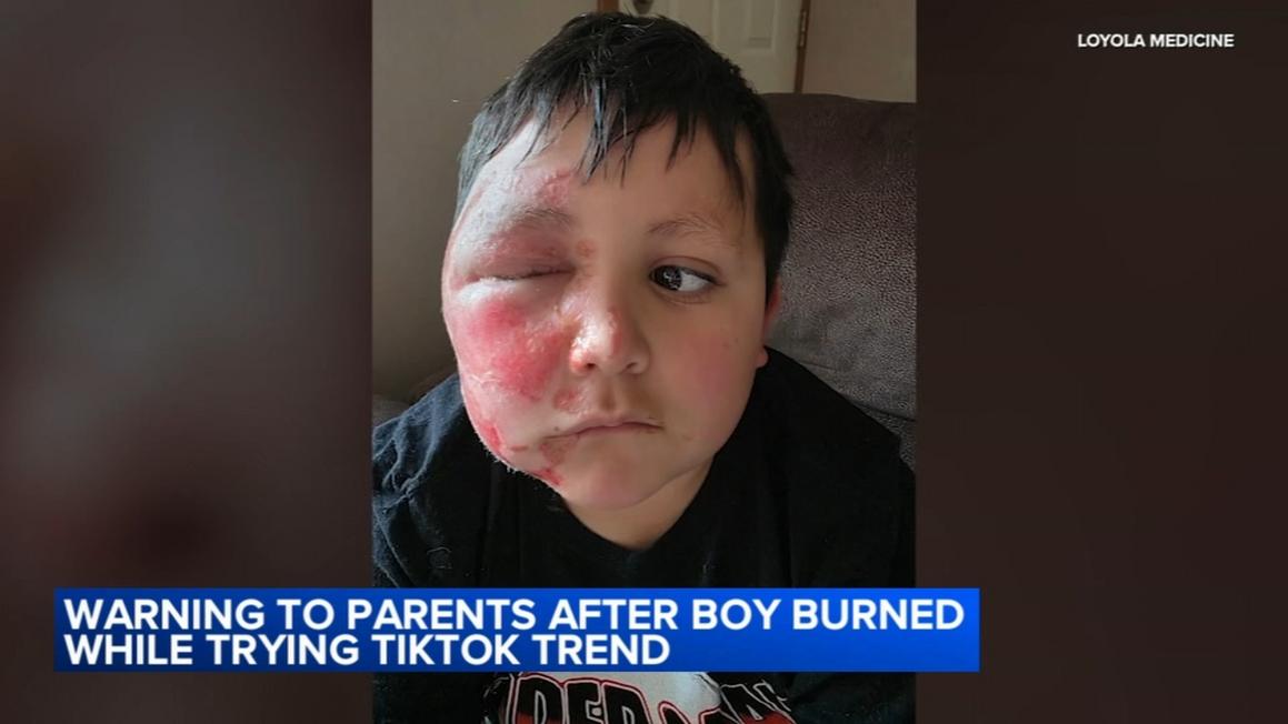 18537776 020326 wls hughes tiktok trend injury 5p vid
