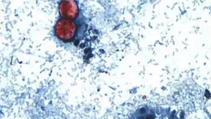 Giới chức y tế liên bang điều tra 5 ổ dịch Cyclosporiasis, FDA cho biết