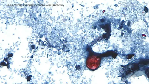 Dịch bệnh Cyclosporiasis lan rộng khắp Hoa Kỳ, California có số ca nhiễm từ 1-10