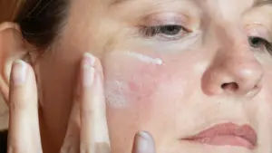 Sản phẩm chăm sóc da được bác sĩ da liễu khuyên dùng cho bệnh rosacea và da ửng đỏ