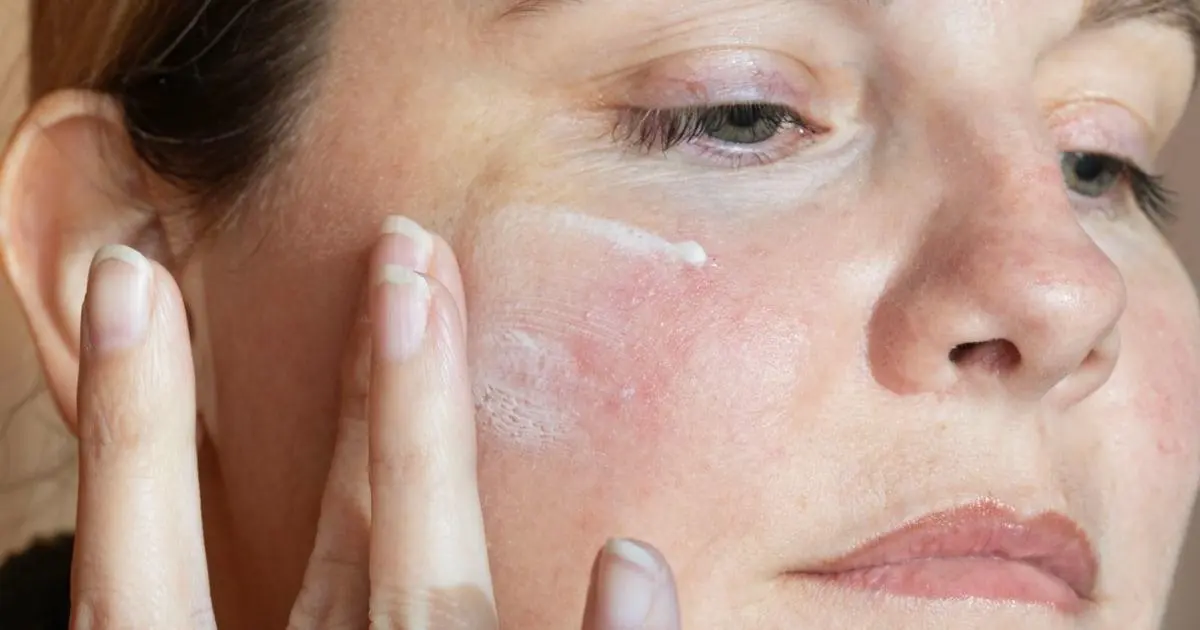 Sản phẩm chăm sóc da được bác sĩ da liễu khuyên dùng cho bệnh rosacea và da ửng đỏ