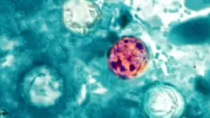 Hàng ngàn người nhiễm bệnh tiêu hóa Cyclosporiasis tại 31 tiểu bang Hoa Kỳ