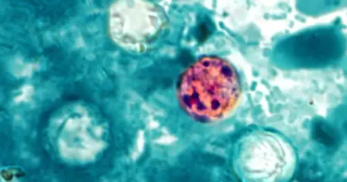Hàng ngàn người nhiễm bệnh tiêu hóa Cyclosporiasis tại 31 tiểu bang Hoa Kỳ