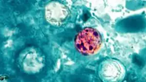 Bản đồ Cyclosporiasis: 29 tiểu bang đang điều tra bệnh tiêu chảy