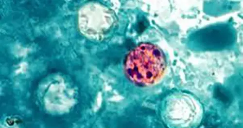 Bản đồ Cyclosporiasis: 29 tiểu bang đang điều tra bệnh tiêu chảy
