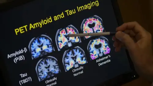 Ngày Alzheimer Thế giới: Biết sớm, hành động sớm