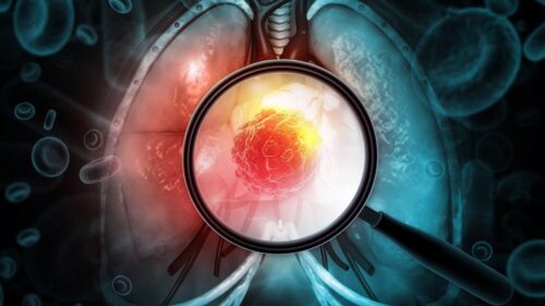 Ung thư phổi adenocarcinoma: Lời giải thích từ bác sĩ về căn bệnh sau chẩn đoán của Giáo hoàng Leo XIV